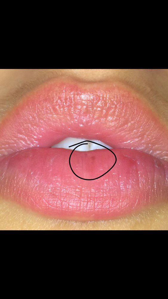 Les moyens de défense de soleil de la pigmentation sur la personne