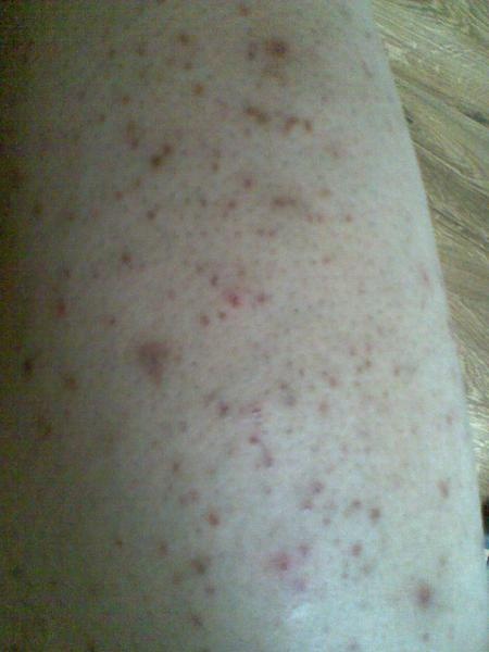 probleme de bouton sur les jambes apres épilation a la ... probleme de bouton sur les jambes apres épilation a la ...