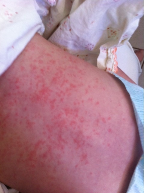 Atopitchesky la dermatite le traitement izrail