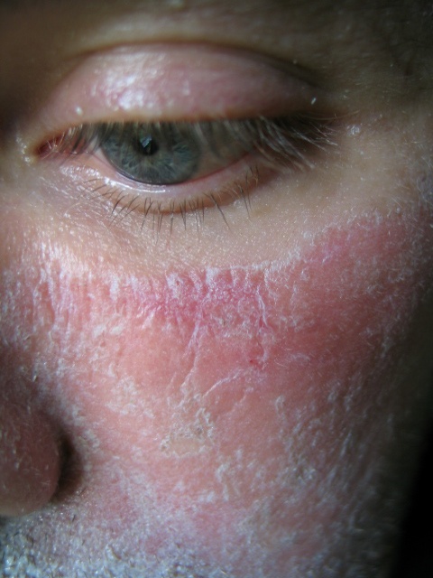 peeling peau acnéique 80 peeling peau acnéique 80