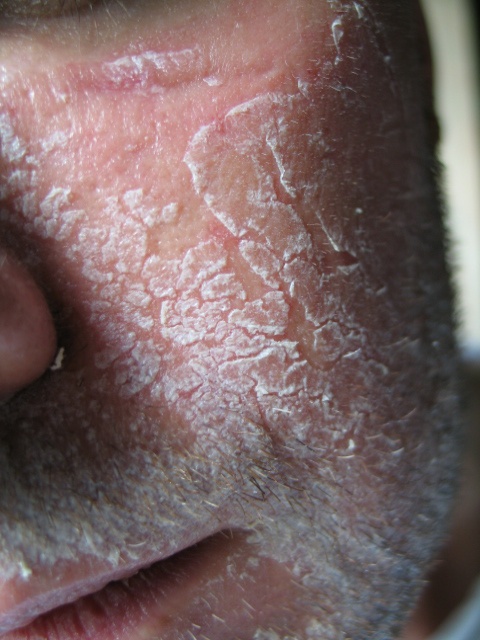 Le sanatorium pour le traitement du psoriasis oukraina