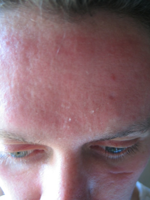 Le psoriasis Le psoriasis