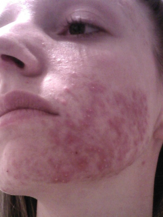 MON COMBAT - Page : 3 - Acné, psoriasis et problèmes de MON COMBAT - Page : 3 - Acné, psoriasis et problèmes de