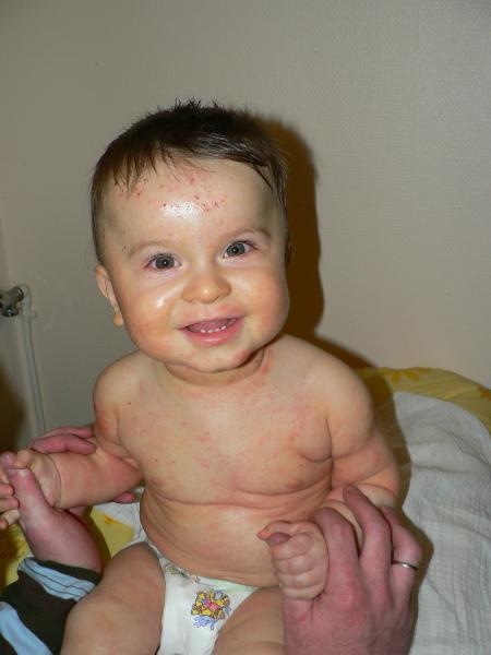 Longuent du psoriasis des paumes