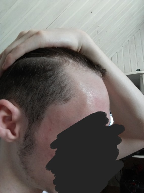 Help] Alopécie précoce ou pas ?? - International Hair Loss Forum