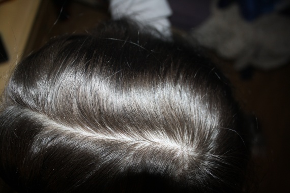 Dessus de la tête - Cheveux Mars 2013 / Minoxidil 2% Dessus de la tête - Cheveux Mars 2013 / Minoxidil 2%