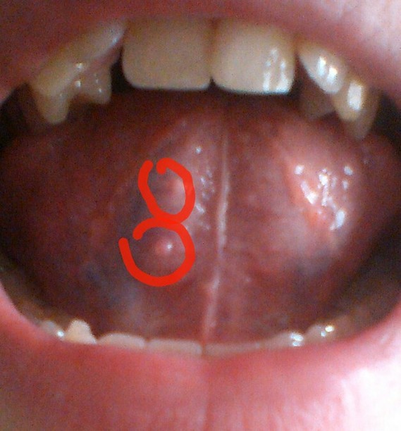 petit bouton blanc sur la langue bébé 2 ans