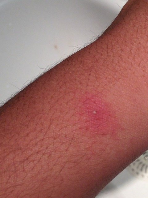 Des eczémas sur la peau