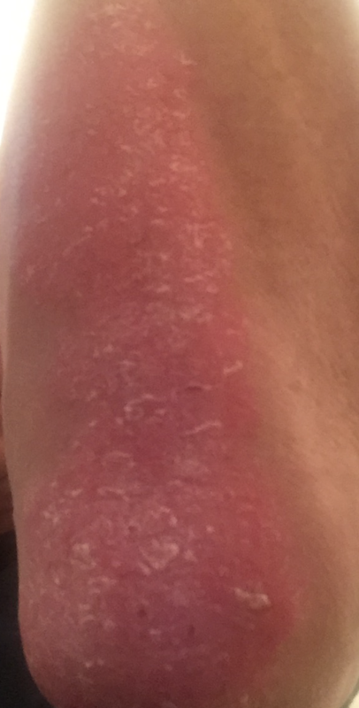 Le psoriasis lui est transmis de la personne chez la personne