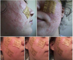 Le traitement du psoriasis par le jus de la chélidoine