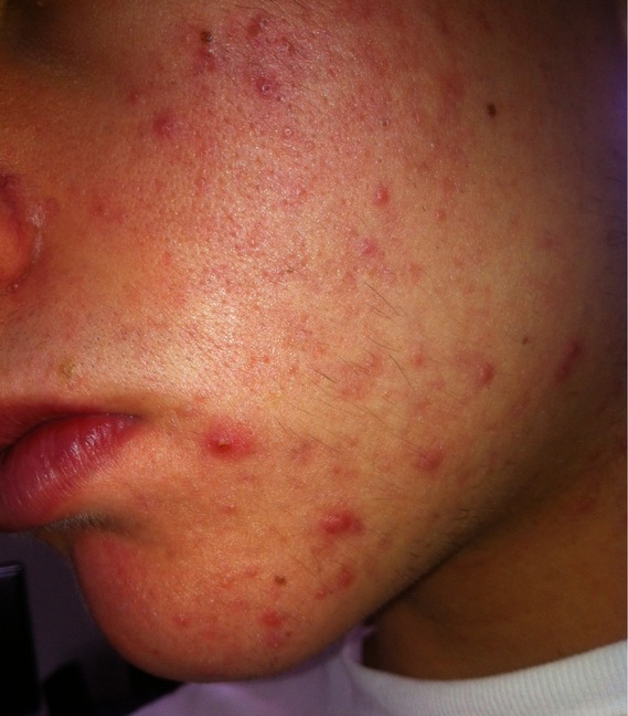 Acné et Roaccutane - Acné - Acné, psoriasis et problèmes Acné et Roaccutane - Acné - Acné, psoriasis et problèmes