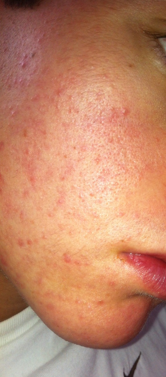 Acné et Roaccutane - Acné - Acné, psoriasis et problèmes Acné et Roaccutane - Acné - Acné, psoriasis et problèmes