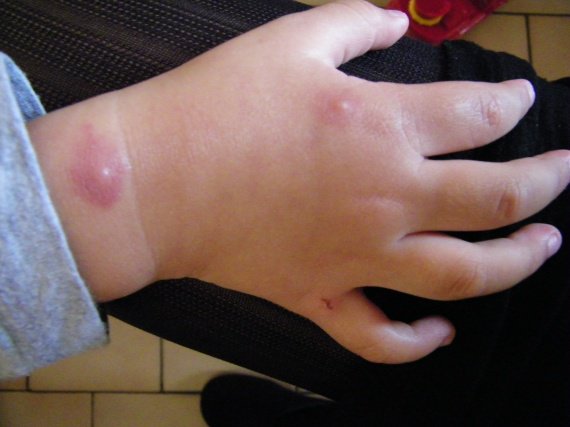 Comme enlever les boutons sur la personne le traitement