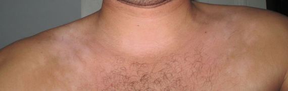 La peau de la tache de rousseur selon le corps