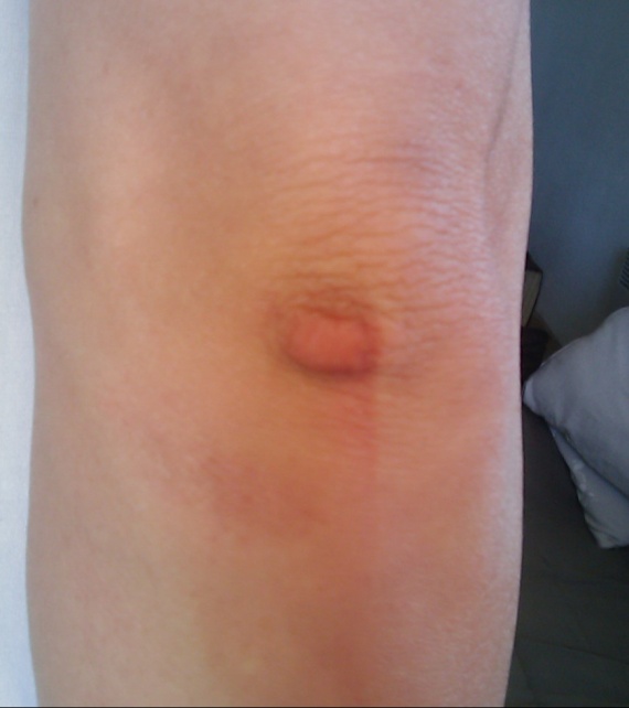 Artropatitchesky le psoriasis que cela