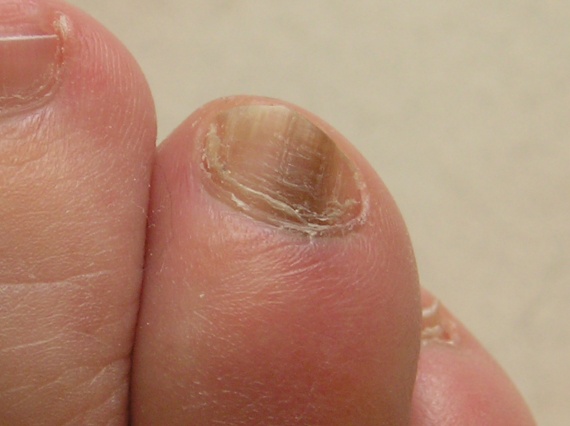 Quelle crème du psoriasis choisir