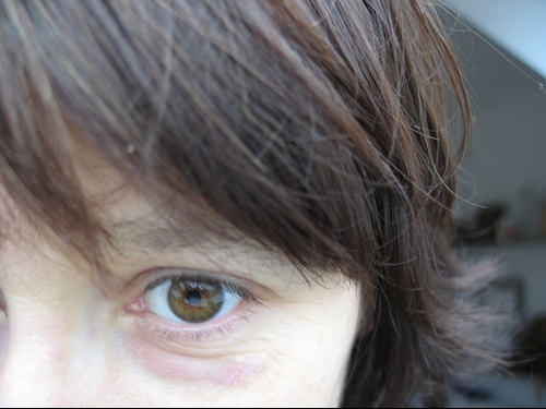 Toxine botulique sur le contour des yeux : effets Toxine botulique sur le contour des yeux : effets