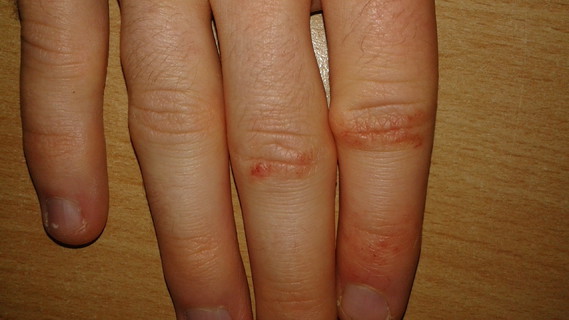 La maladie le psoriasis de pour quoi