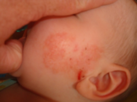 La graisse de blaireau au psoriasis de la tête