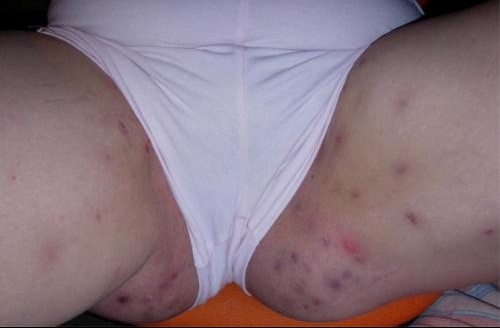 De quoi il y avoir être des boutons malades de refroidissement sur la personne