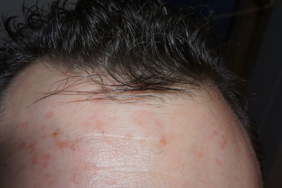 Plaque rouge sur le front - Acné, psoriasis et problèmes Plaque rouge sur le front - Acné, psoriasis et problèmes