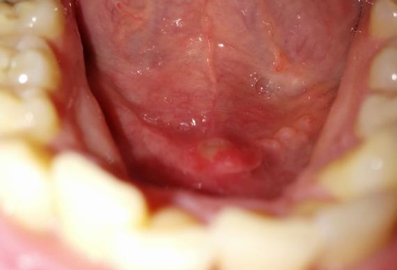 La crème de nejrodermita lhormonale