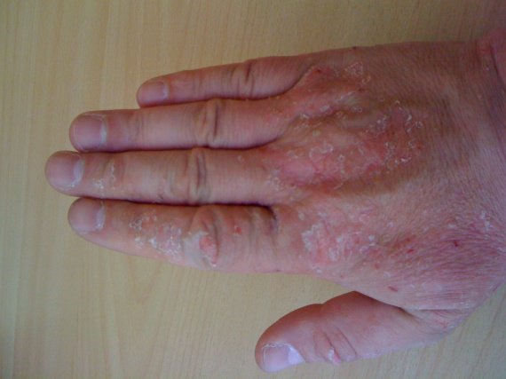 La raison de lapparition du psoriasis des ongles