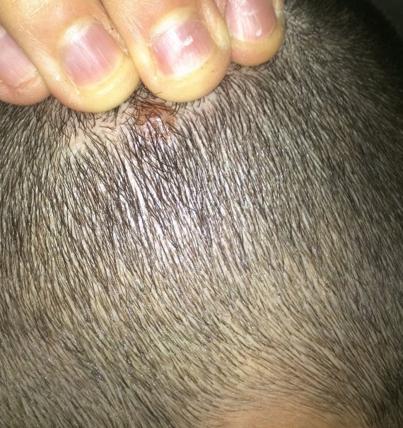 Comme passe le traitement du psoriasis