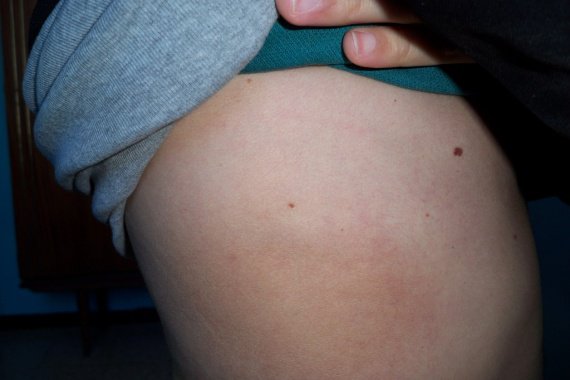 Le traitement du psoriasis à kitai