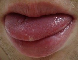 herpes sur la langue