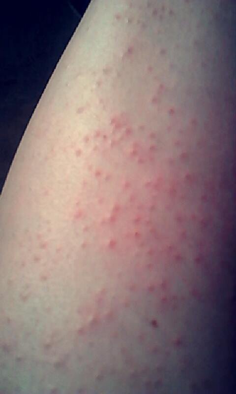 Allergie Nutella Boutons Peter Skaggs