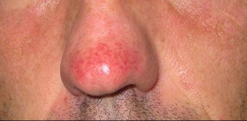 Le psoriasis sur la tête que traiter les maisons