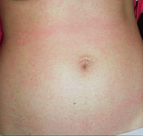 Se distingue leczéma du psoriasis