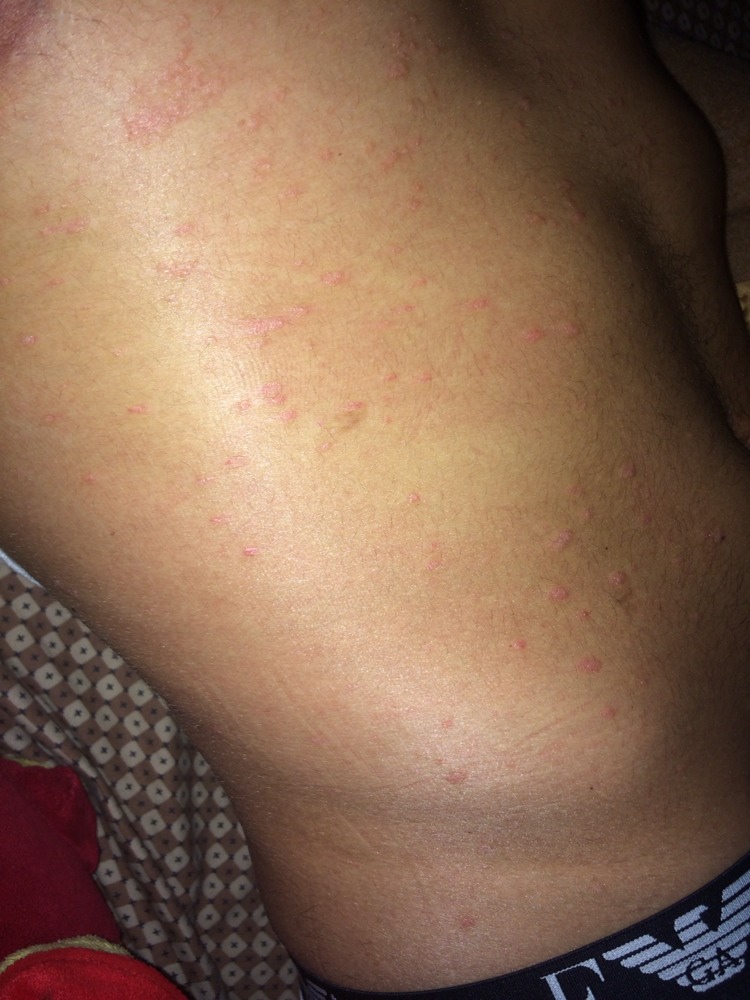 Le moyen des eczémas et le psoriasis à bras