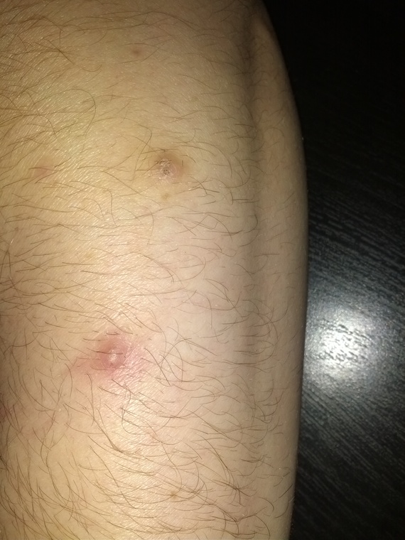 Le psoriasis sur la personne se desquament