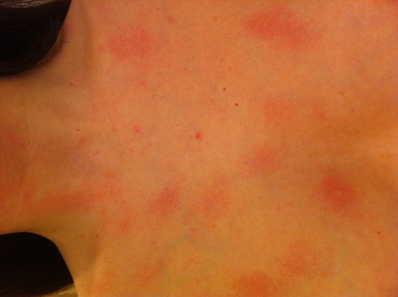 Plaques rouge, petits bouton, et démongeasions Plaques rouge, petits bouton, et démongeasions