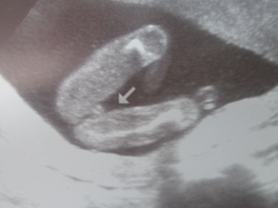 sexe foetus modèle sexe sexe foetus modèle sexe