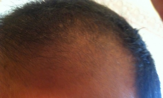 Mon Expérience Minoxidil 5% - Calvitie et perte de cheveux Mon Expérience Minoxidil 5% - Calvitie et perte de cheveux
