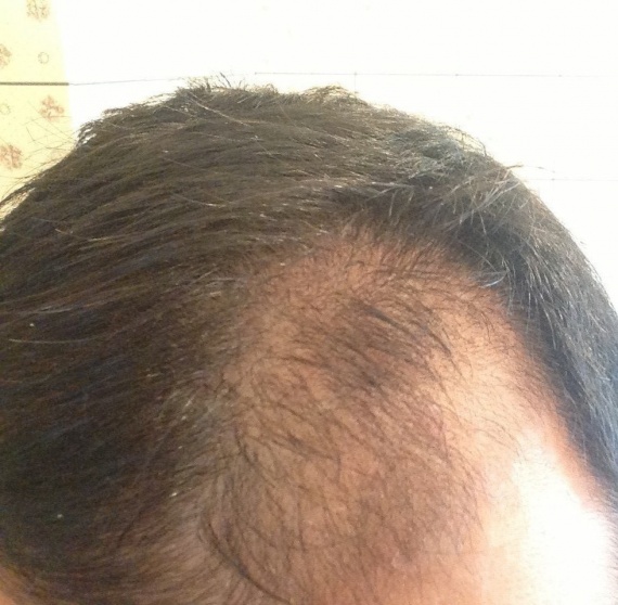 Mon Expérience Minoxidil 5% - Calvitie et perte de cheveux Mon Expérience Minoxidil 5% - Calvitie et perte de cheveux