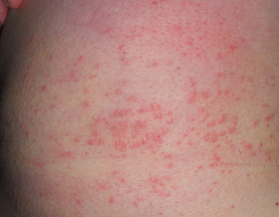 Emoksipin dans le traitement du psoriasis