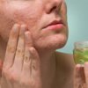 Comment éliminer les marques de l’acné avec des remèdes naturels
