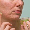 6 remèdes maison pour éliminer l’acné et les points noirs