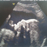 Perte Epaisse Transparente Et Gluante Courbe De Temperature Ovulation Forum Grossesse Amp Bebe Doctissimo