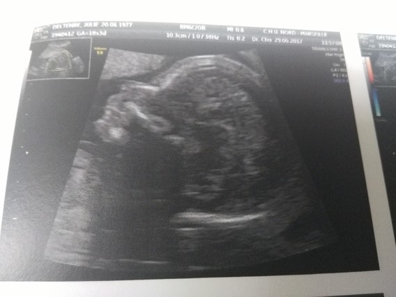 Help Bien Naitre Echo A 18 Sa Corps Calleux Help Bien Naitre Echo A 18 Sa Corps Calleux