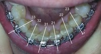 Blop-i - orthodontie - Boîtiés mal positionnés