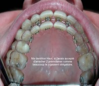 2013-12-08 - Ma dentition haut avec 2 extractions