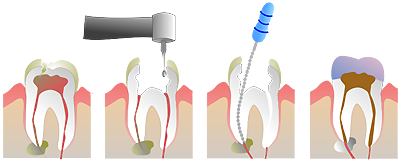 Endodontique