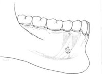 Mandibule - Canal dentaire inférieur 004