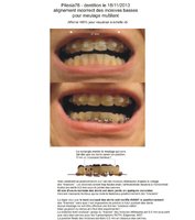 Pilesia78 - dentition en position