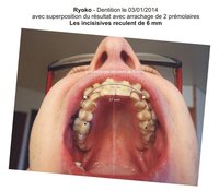 Ryoko - dentition 002 avec arrachages